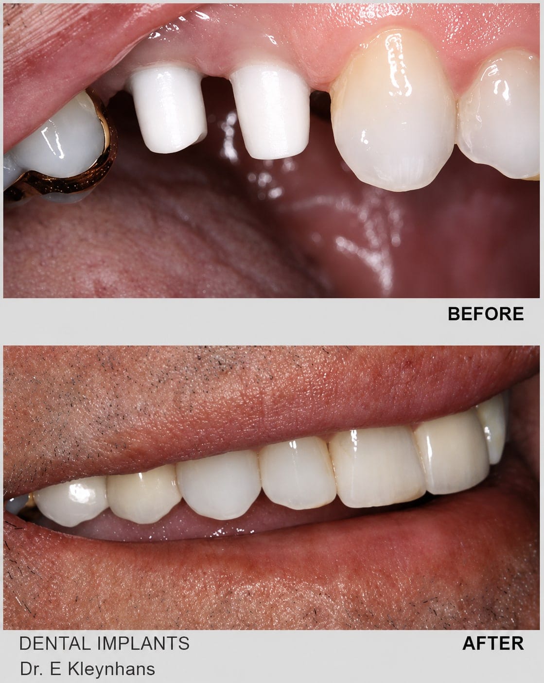 Before and after dental implant tooth replacement by Dr Eugene Kleynhans at Smile Connection Dental Studio, Pretoria