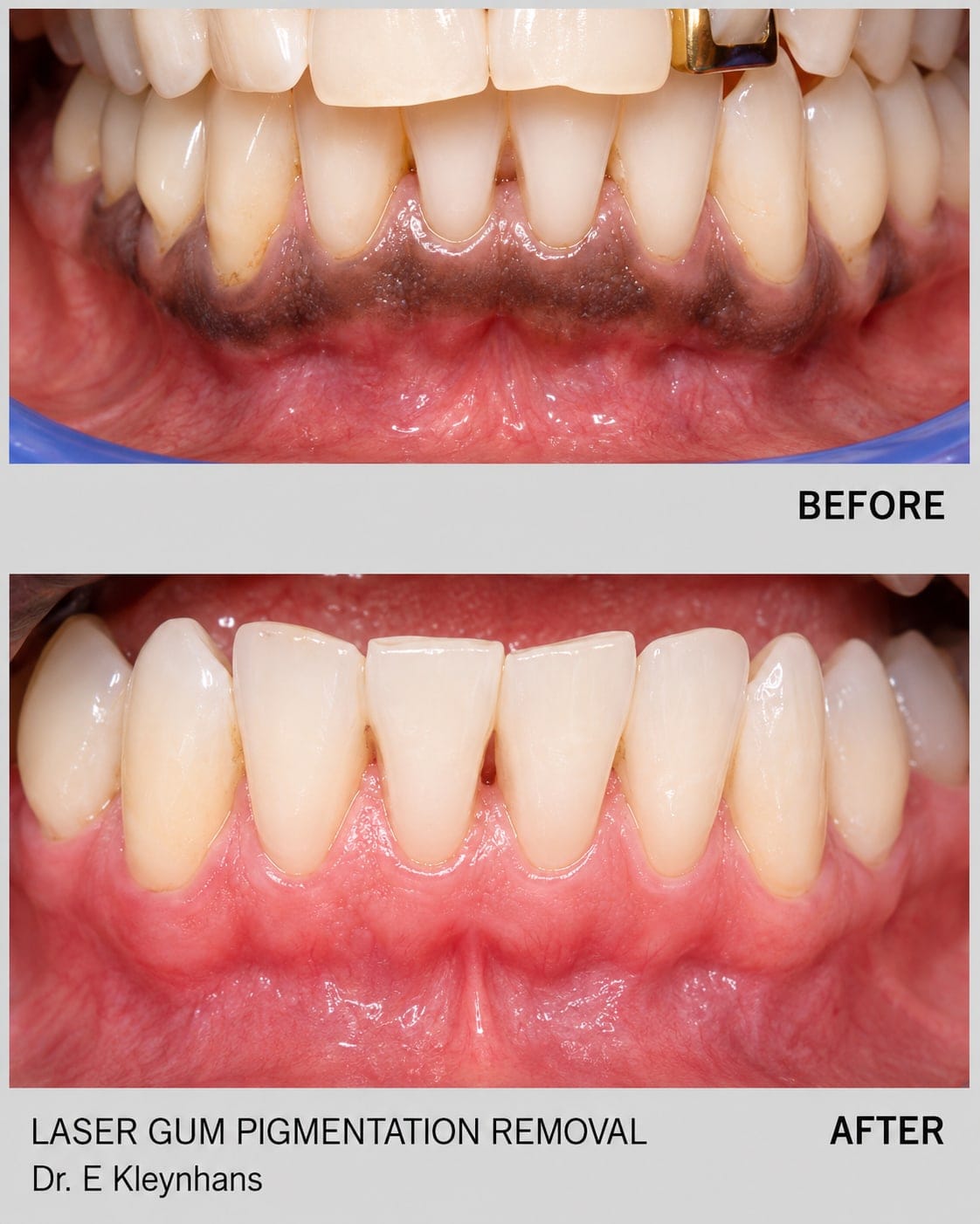 Before and after laser gum pigmentation removal by Dr Eugene Kleynhans at Smile Connection Dental Studio, Pretoria
