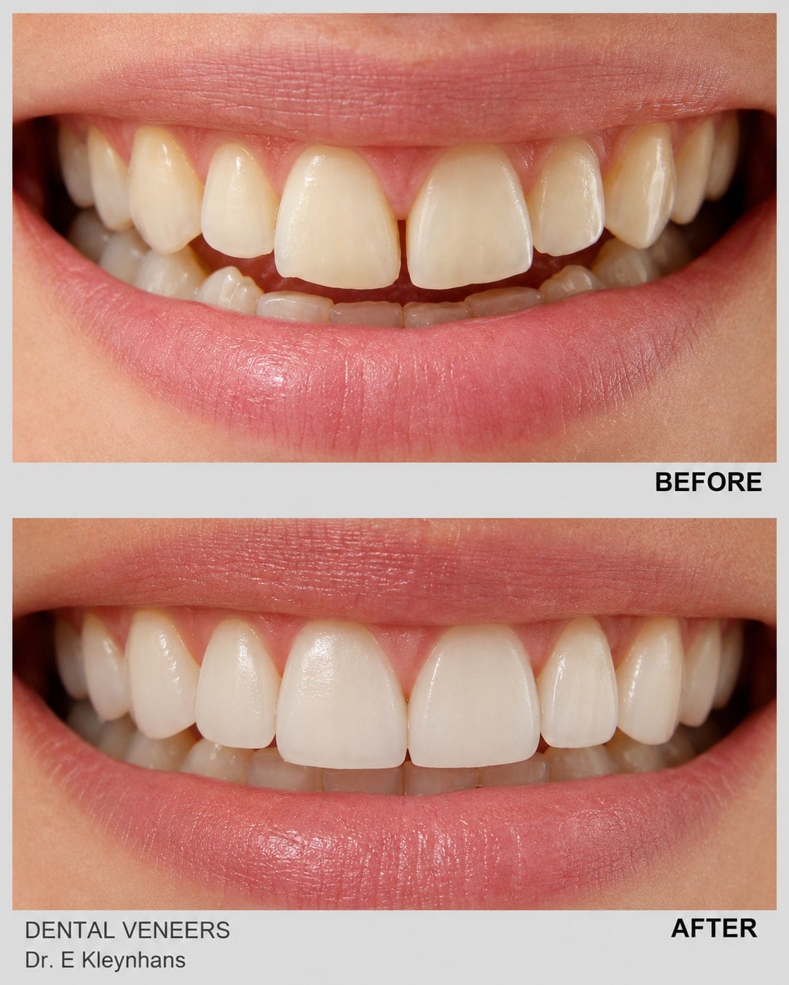 Before and after porcelain veneers smile makeover by Dr Eugene Kleynhans at Smile Connection Dental Studio, Pretoria